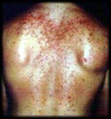 Steroid injection for acne side effects